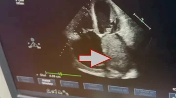 استئصال ورم نادر من قلب مريض سبعيني بقصر العيني