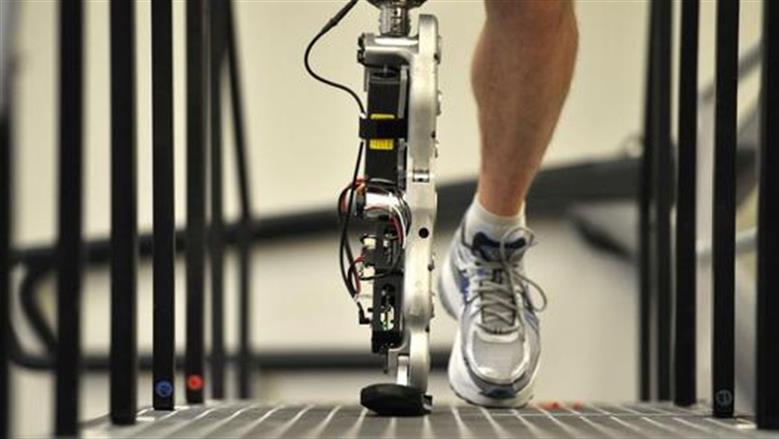 تكاليف الأطراف الصناعية في مصر 2026.. خيارات متعددة لذوي الهمم