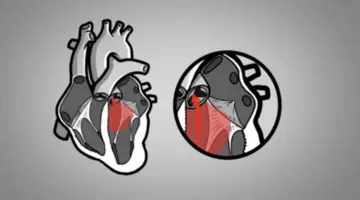 متى يكون ارتخاء الصمام الميترالي خطير؟- حسام موافي يكشف