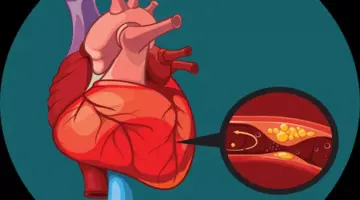 مرض الشريان التاجي- حسام موافي يوضح العمر الأكثر إصابة به